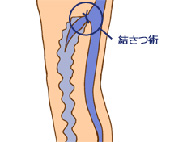 高位結紮(けっさつ)術